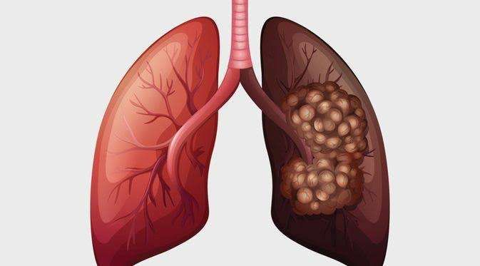 Kenali Jenis Penyakit Kanker Paru-paru paling Mematikan