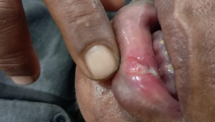 Sorakhmat Telaumbanua Desak Kapolres Tapteng Tangkap Tersangka Tindak Pidana Penganiayaan.